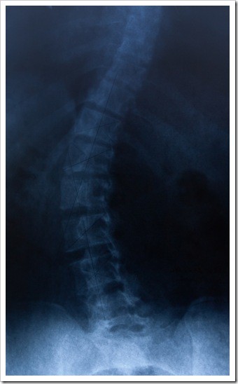 Sunnyvale Scoliosis Treatment